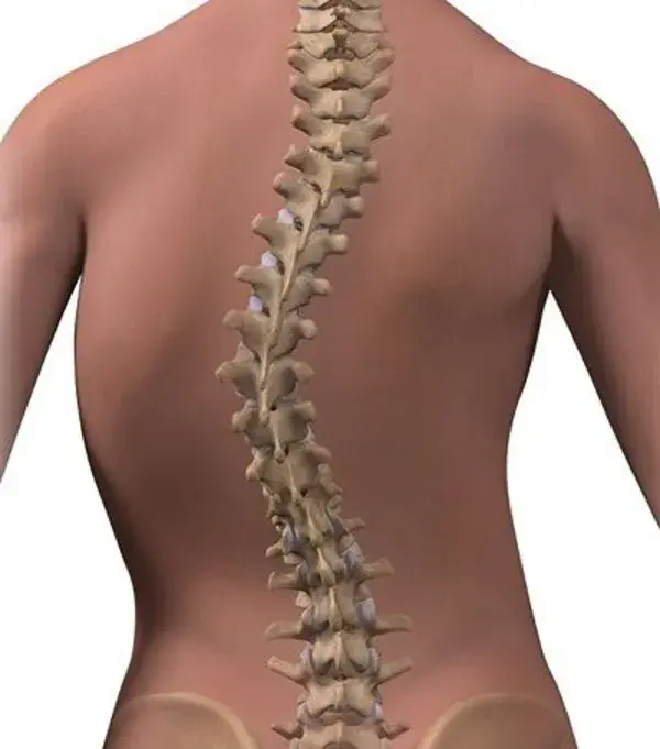 www.scoliosissos.com