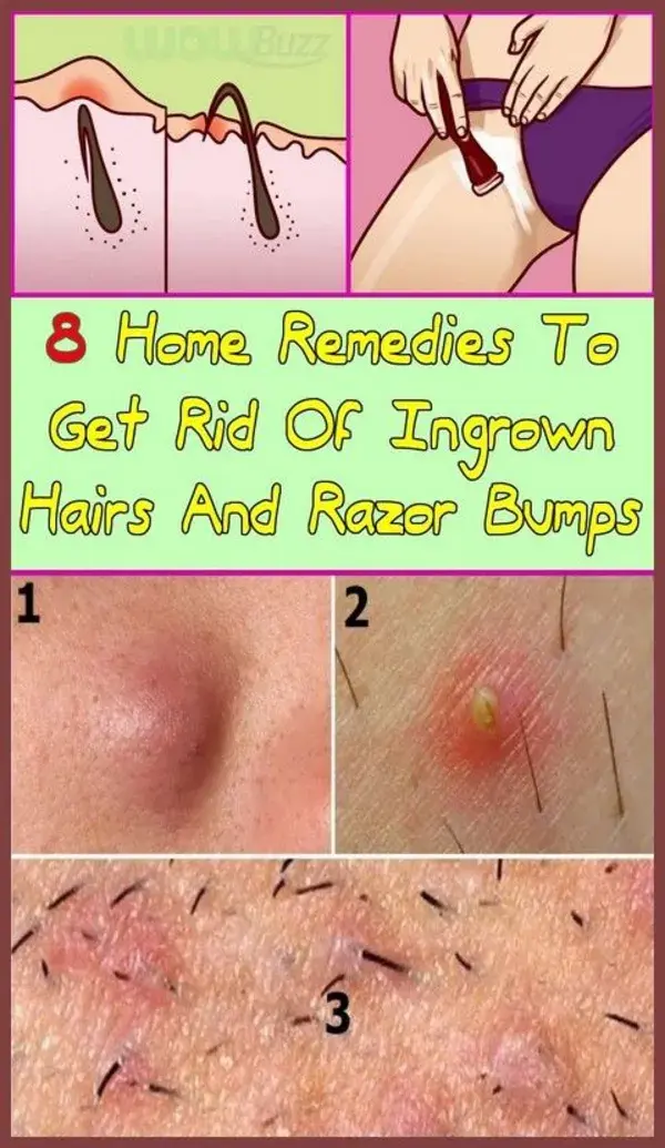 Great Trick With Which You Will No Longer Have Ingrown Hairs After Shaving