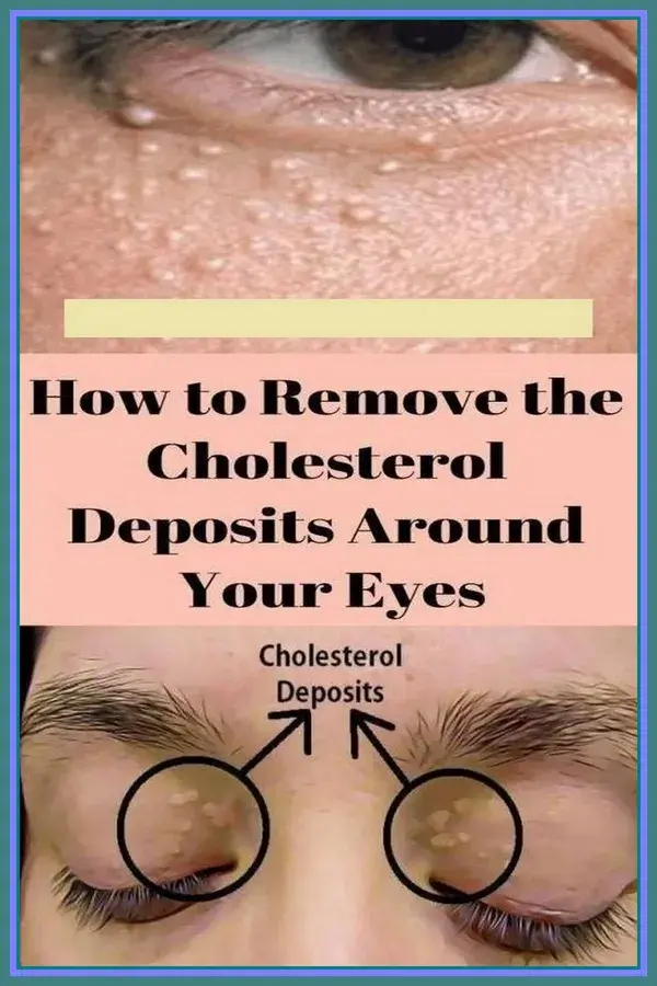 7 Remedies To Get Rid Of Cholesterol Milk Spots Naturally