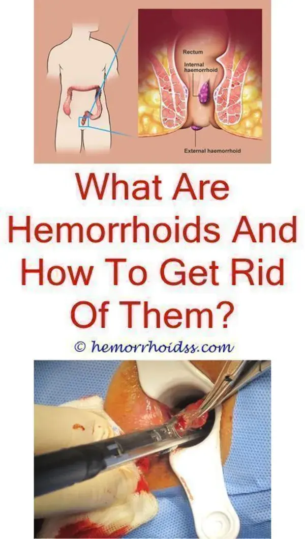 6 Hemorrhoid Ointments & Home Remedies to Try