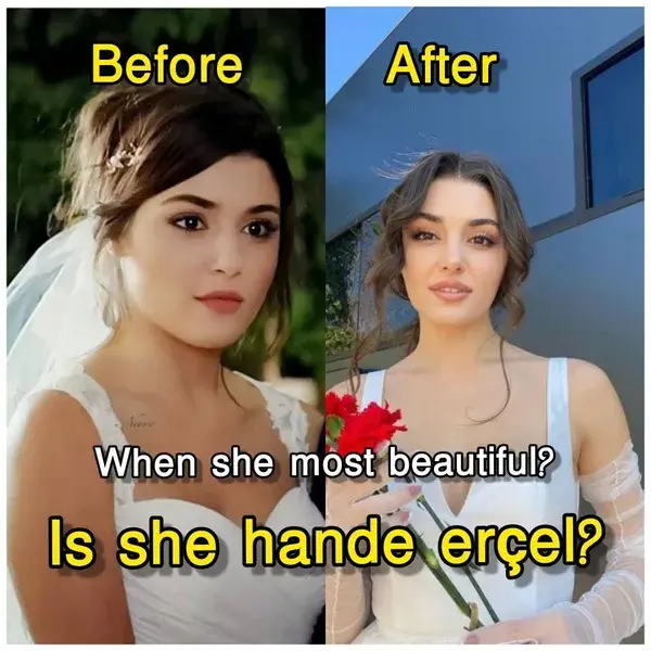 Hande erçel after plastic surgery