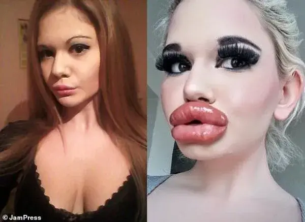 Real-Life Barbie’ Andrea Ivanova” with the ‘biggest lips in the world’ shows off huge new pout after 20th filler Injection