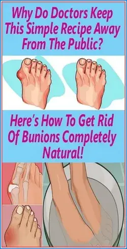 WHY DO DOCTORS KEEP THIS SIMPLE RECIPE AWAY FROM THE PUBLIC? HERE?S HOW TO GET RID OF BUNIONS