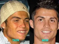 Cristiano Ronaldo Before-After Plastic Surgery