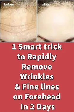 1 Smart trick to Rapidly Remove Wrinkles & Fine lines on Forehead In 2 Days 