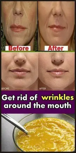How To Remove Deep Mouth Wrinkles Really Fast