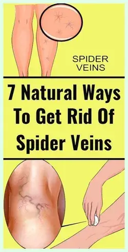 This Natural Ingredient Will Help You Get Rid Of Varicose Veins In Just 3 Days !