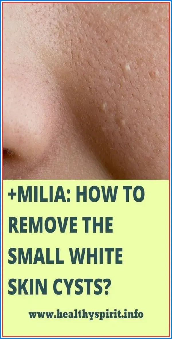 MILIA: HOW TO REMOVE THE SMALL WHITE SKIN CYSTS?