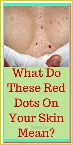 Do You Have These Red Spots On Various Parts Of Your Body? Should You Worry?