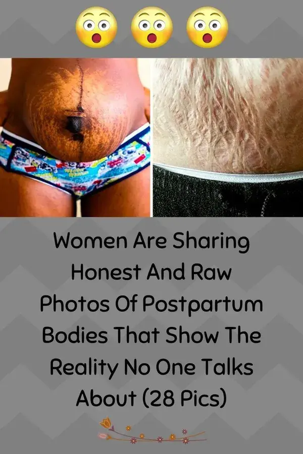 Women Are Sharing Honest And Raw Photos Of Postpartum Bodies That Show The Reality No One Talks