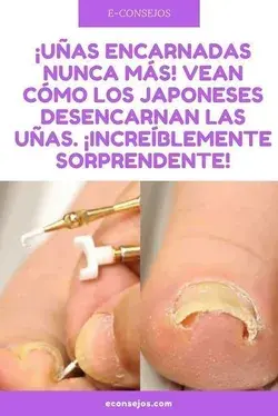 Los mejores remedios caseros para los hongos en las uñas