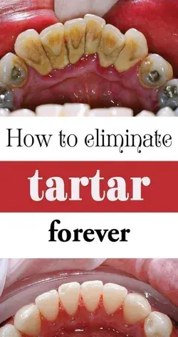 How to Naturally Remove Plaque and Tartar from Teeth