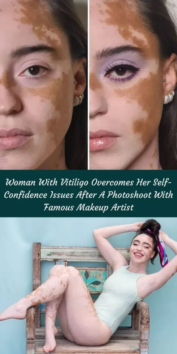 Woman With Vitiligo Overcomes Her Self-Confidence Issues After A Photoshoot With Famous Makeup