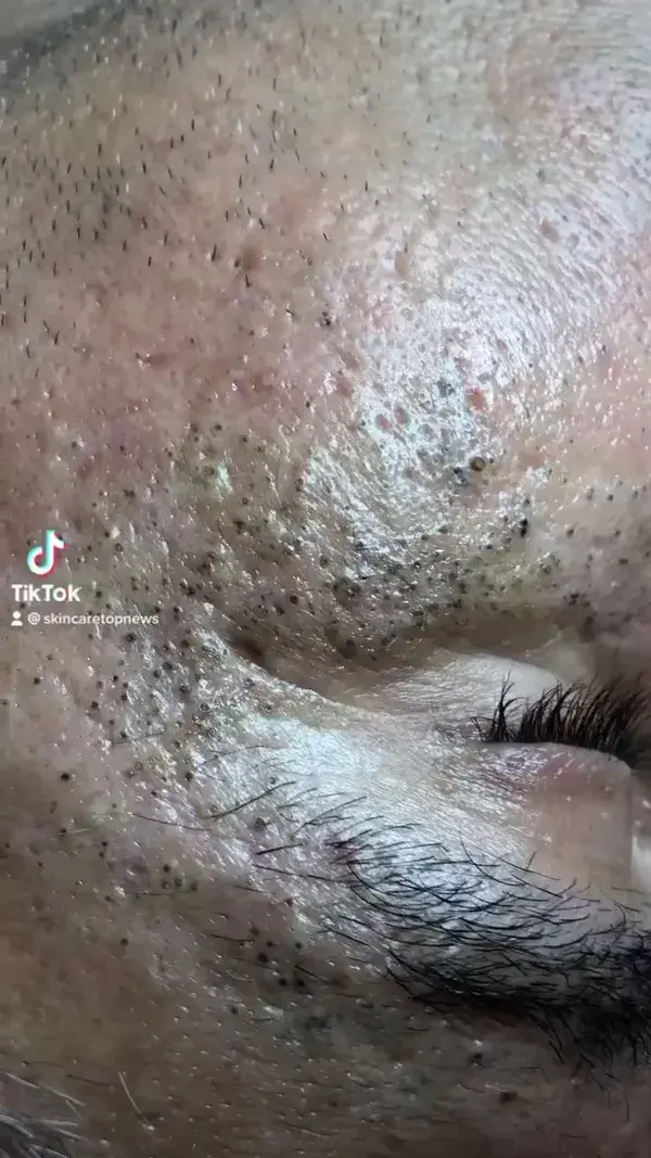 Clean pores