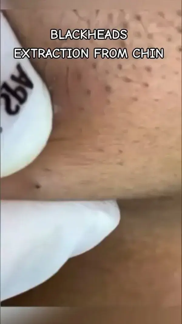 #blackheads removal from chin
