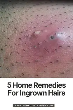 Get Rid Of Blackheads From Face Fast At Home