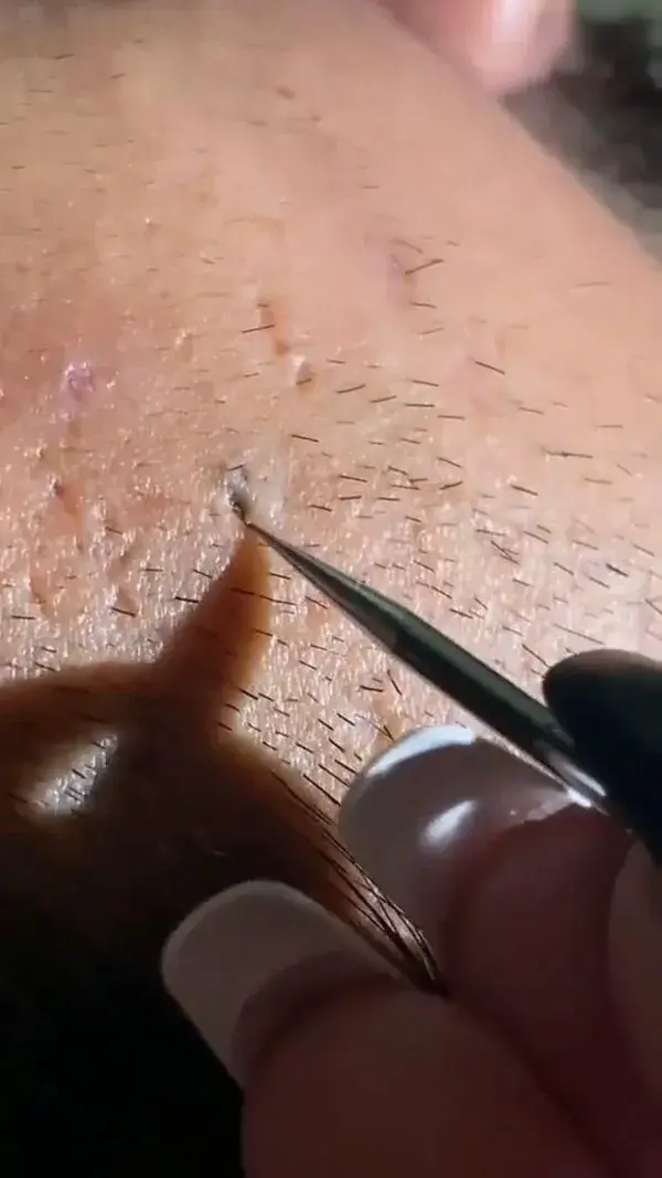 Blackheads extraction satisfying