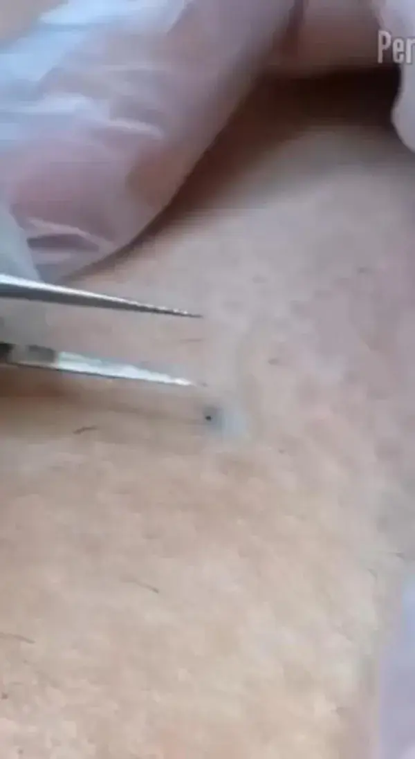 Ingrown hair