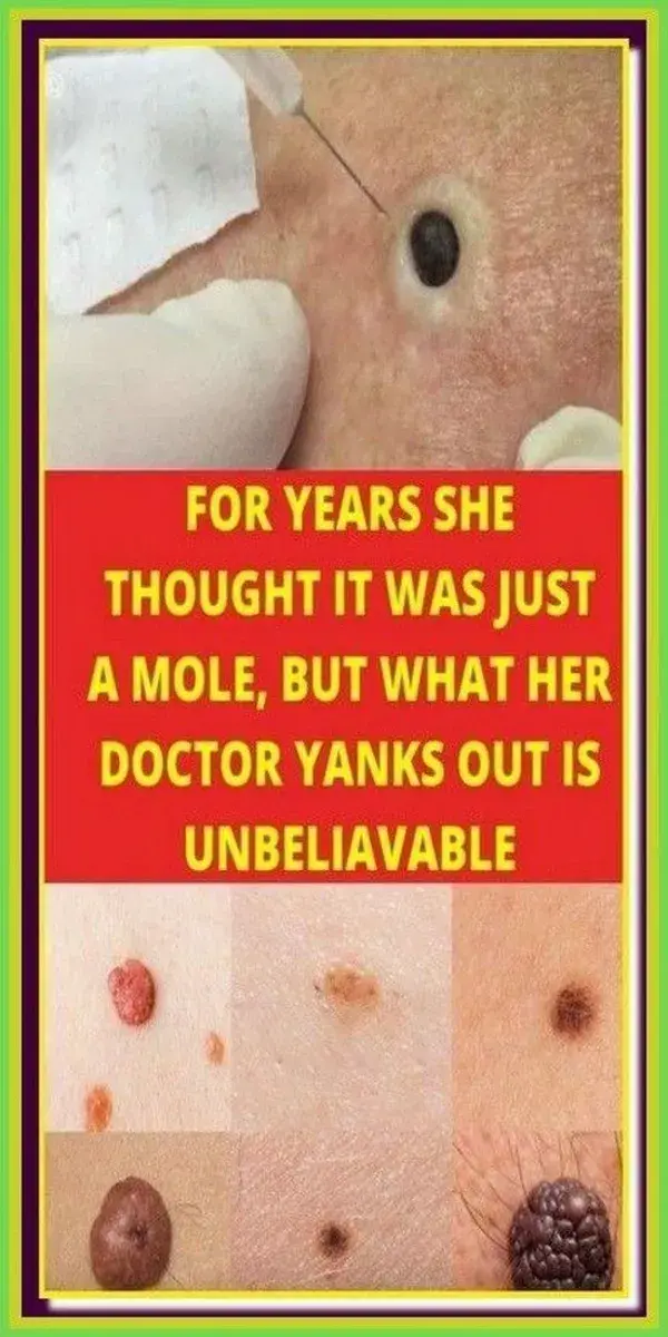 FOR YEARS SHE THOUGHT IT WAS JUST A MOLE, BUT WHAT HER DOCTOR YANKS OUT IS UNBELIAVABLE