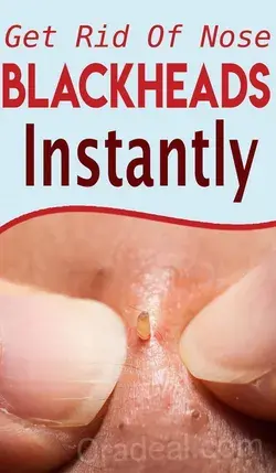Get Rid Of Nose Blackheads Instantly