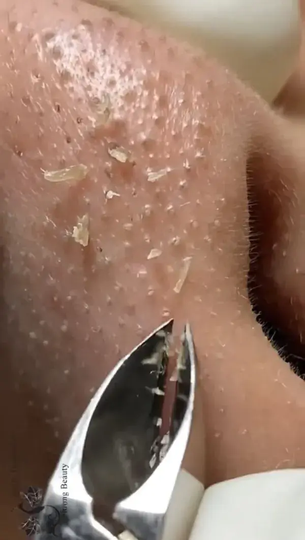 blackheads popping video