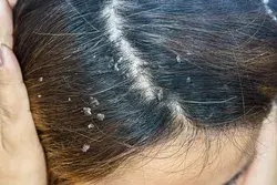 Women warned not to use thrush cream to treat dandruff as it can cause headaches, says hair specialist