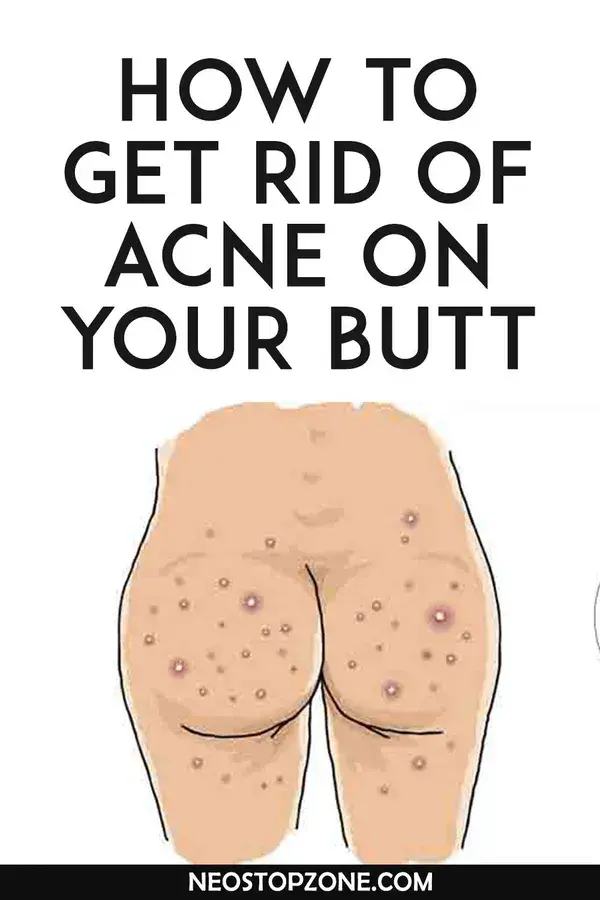 How to Get Rid of Pimples on Your Back