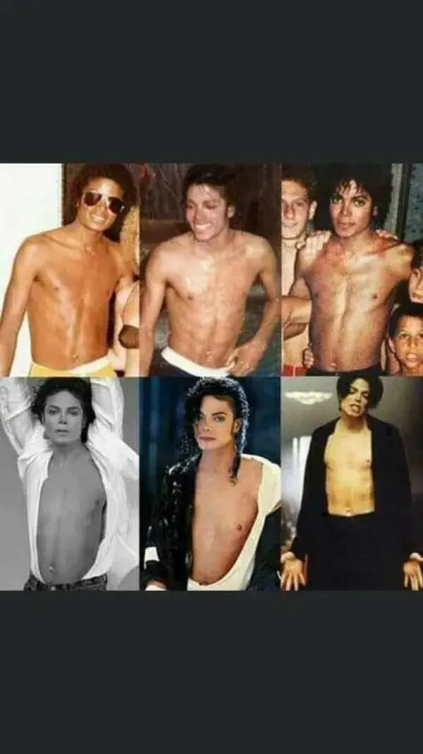 Michael Jackson vitiligo