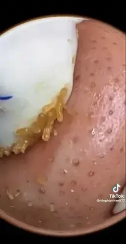 Blackheads Extraction Video