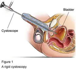 Cystoscopy procedure in India | Healing Touristry
