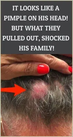 It Looks Like a Pimple on His Head, But What They Pulled Out Shocked Them