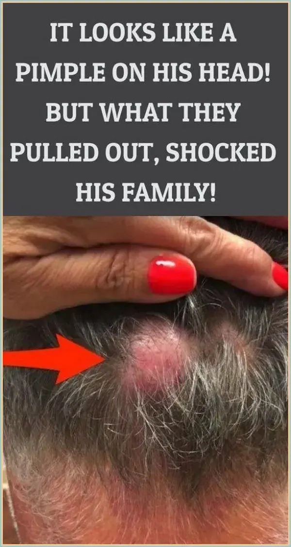 It Looks Like a Pimple on His Head, But What They Pulled Out Shocked Them
