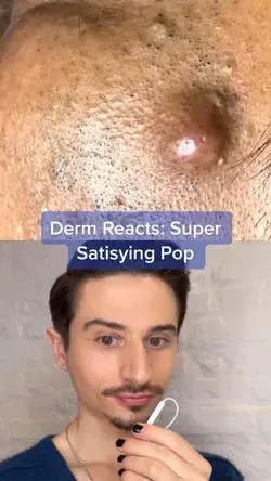 CW: pimple pop