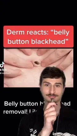 Derm Reacts: “belly button blackhead”