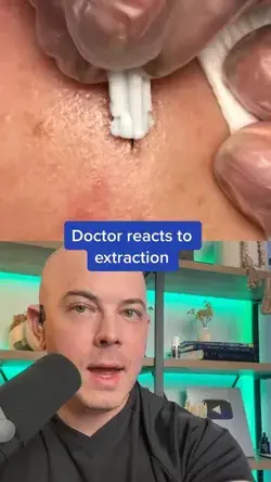 Doctor reacts to super satisfying extraction! #dermreacts #doctorreacts #pimplepopper