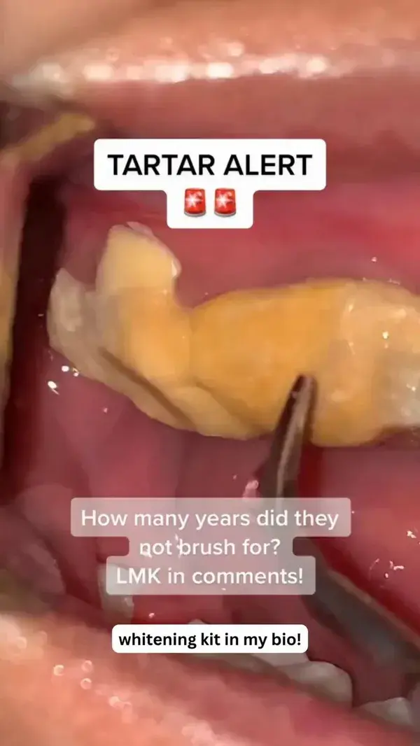 TARTAR ALERT🚨