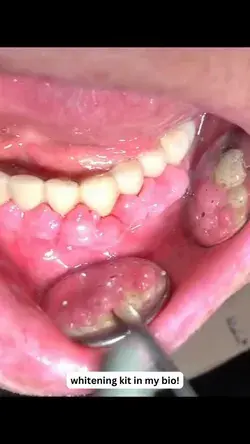 Weird Oral Condition 😱