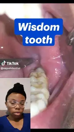 Dentist Expains Wisdom tooth infection