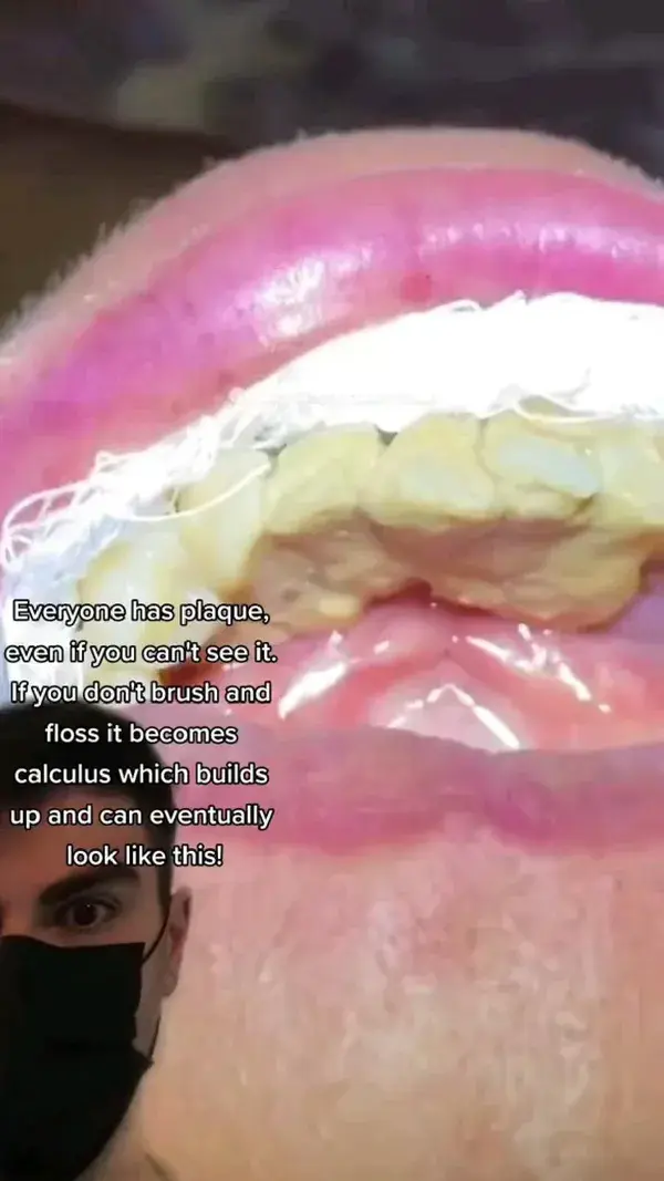 HUGE Tartar removal