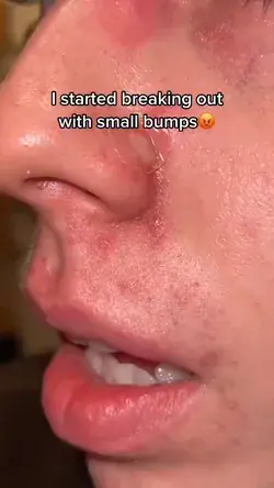 I started breaking out with small bumps