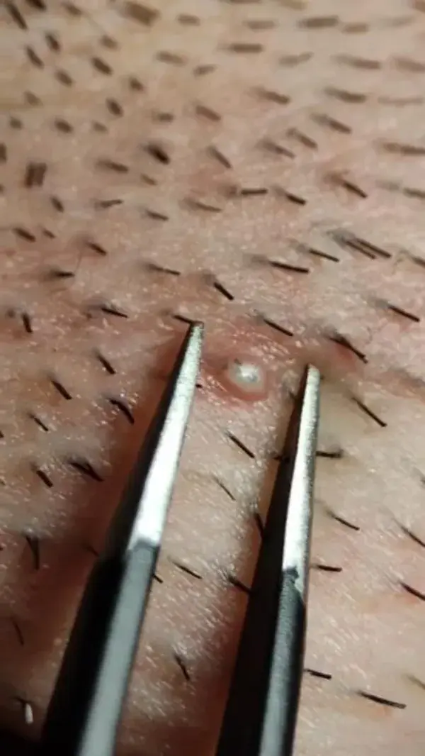 Removing ingrown hairs