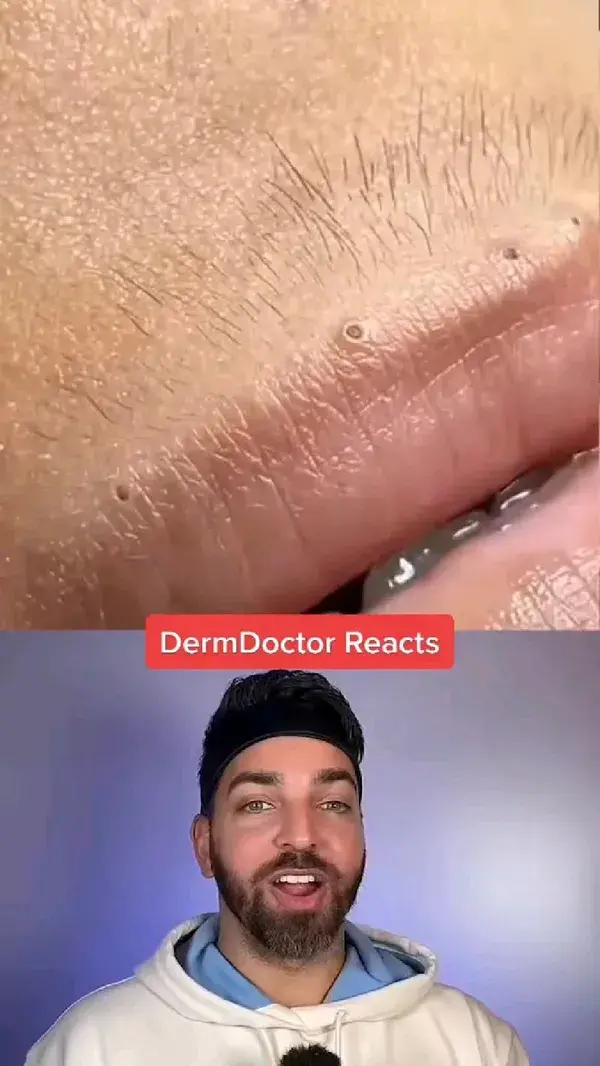 pimples removal