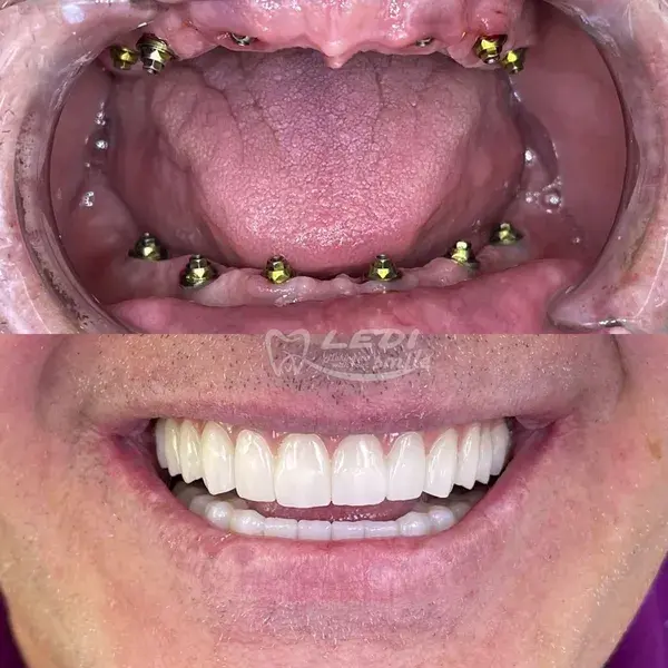 All on 6 implant technique. 24 E-Max zirconia crowns over PEEK implants.