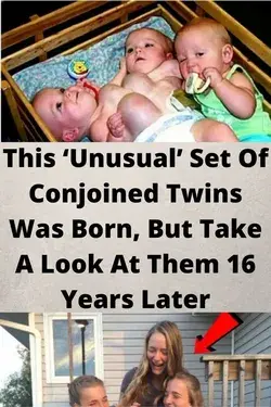 This ‘Unusual’ Set Of Conjoined Twins Was Born, But Take A Look At Them 16 Years Later