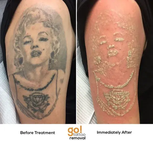 www.gotattooremoval.com