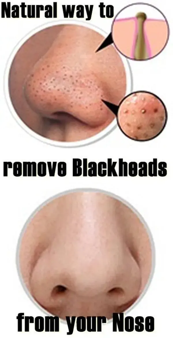 Overnight Magical Trick To Get Rid Of Blackheads From Face Fast At Home