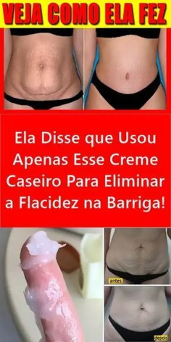 Creme Caseiro Para Eliminar Estrias e Flacidez na Pele!