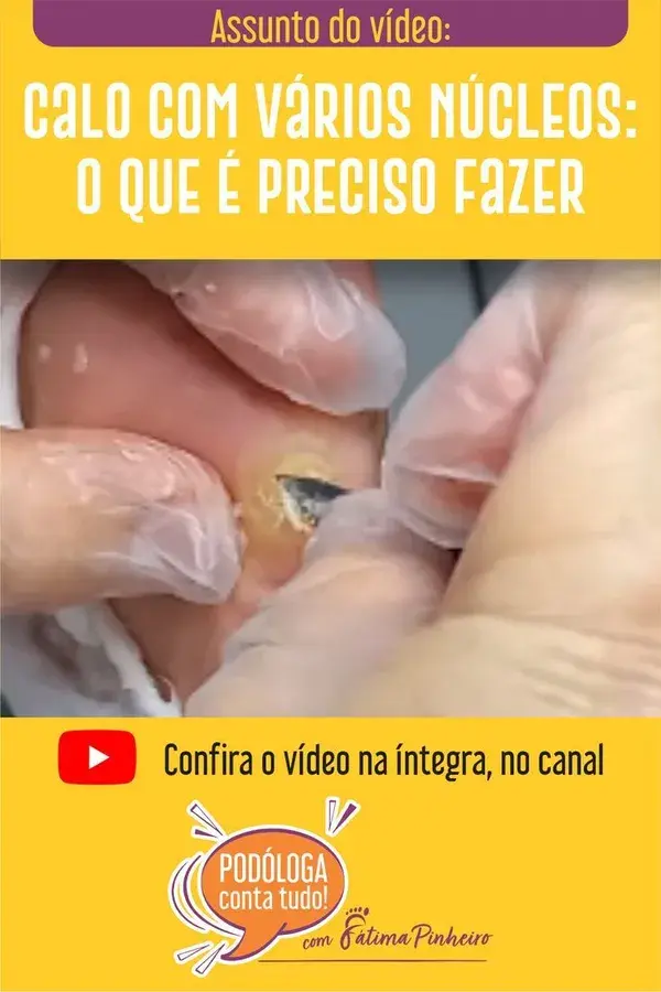 Calo com vários núcleos