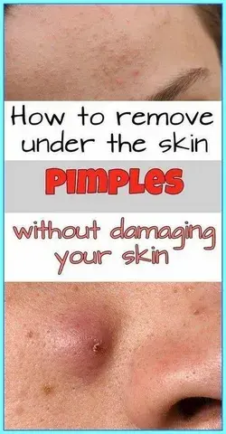 How to Remove Under the Skin Pimples Without Damaging Your Skin