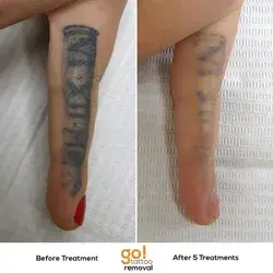 www.gotattooremoval.com